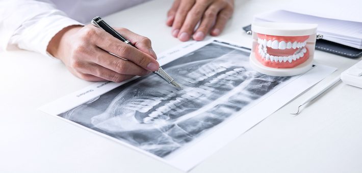 Como ter um novo sorriso em menos de 24 horas? Carga Imediata