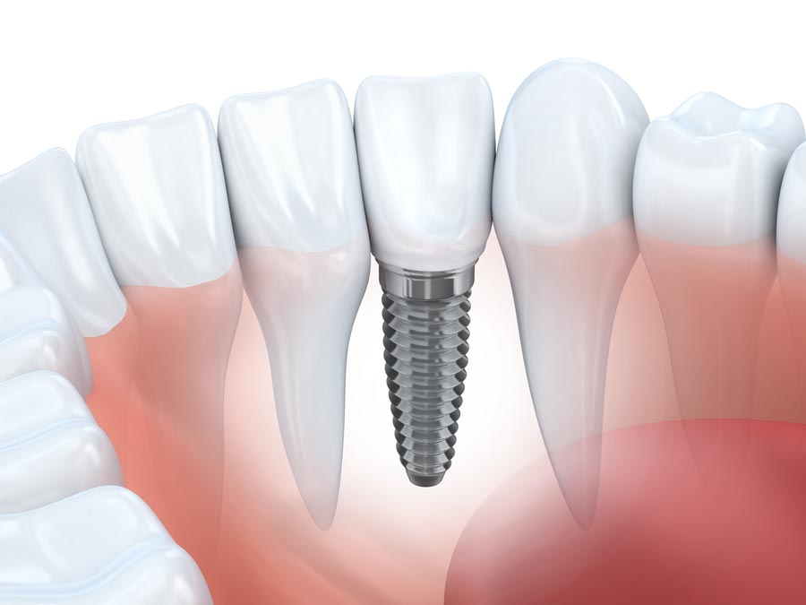 Implantes dentários