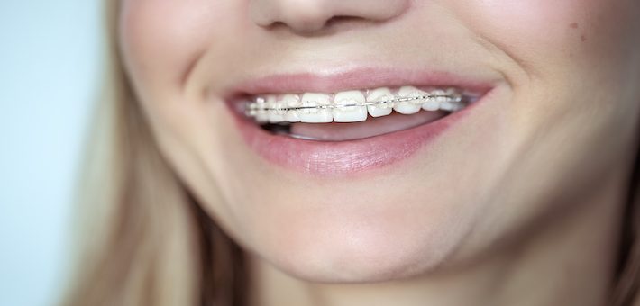 Aparelho dentário – Ortodontia – As melhores recomendações para si!